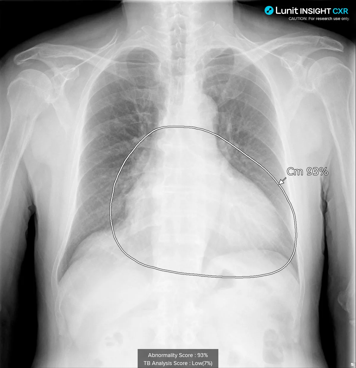 Cardiomegalia