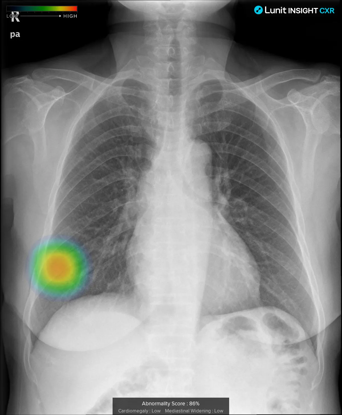 Nódulo pulmonar