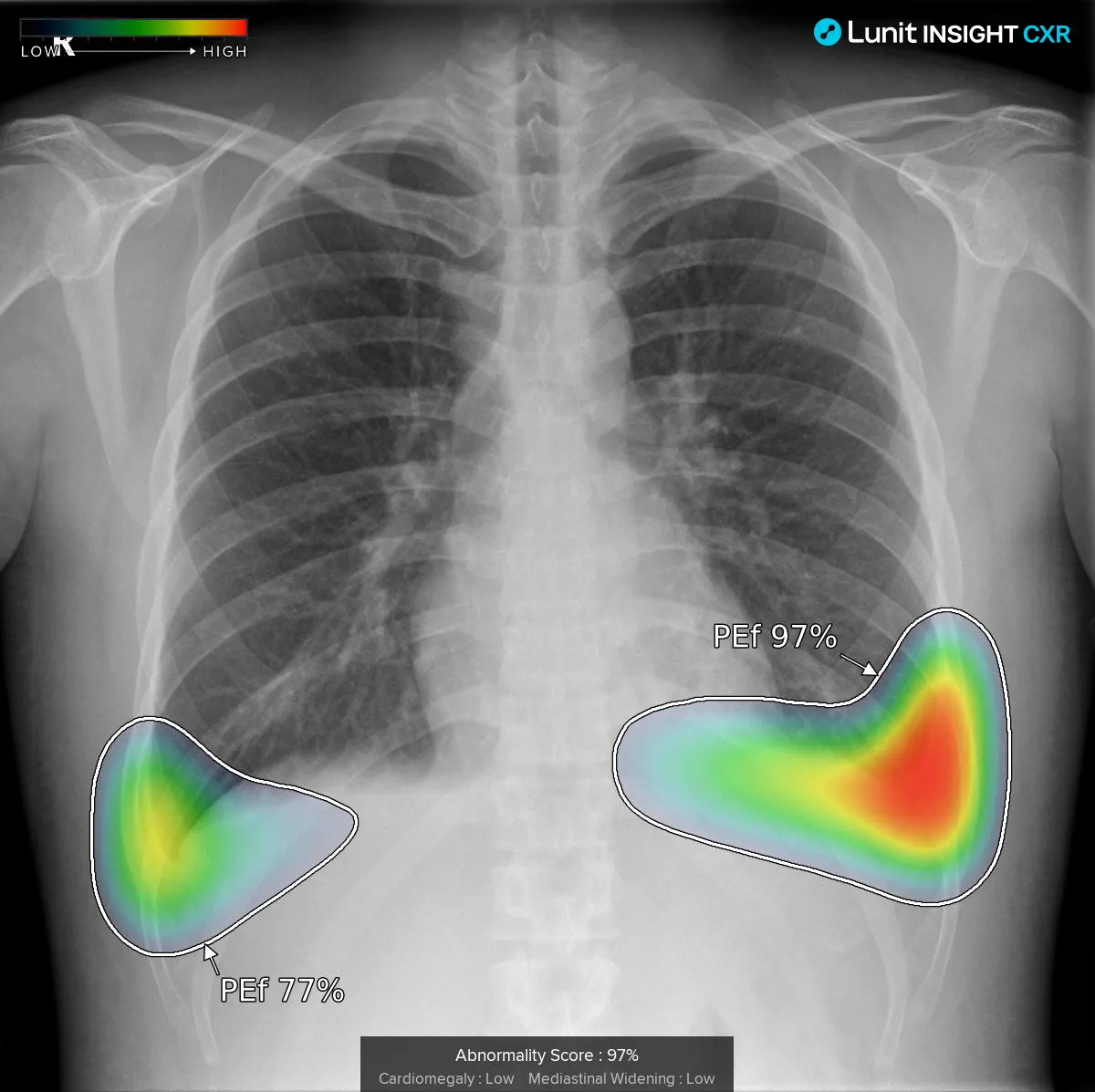 Derrame pleural