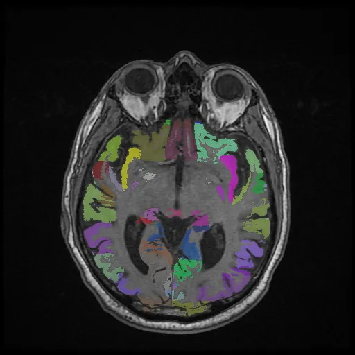 Estudio de ejemplo: segmentación cerebral