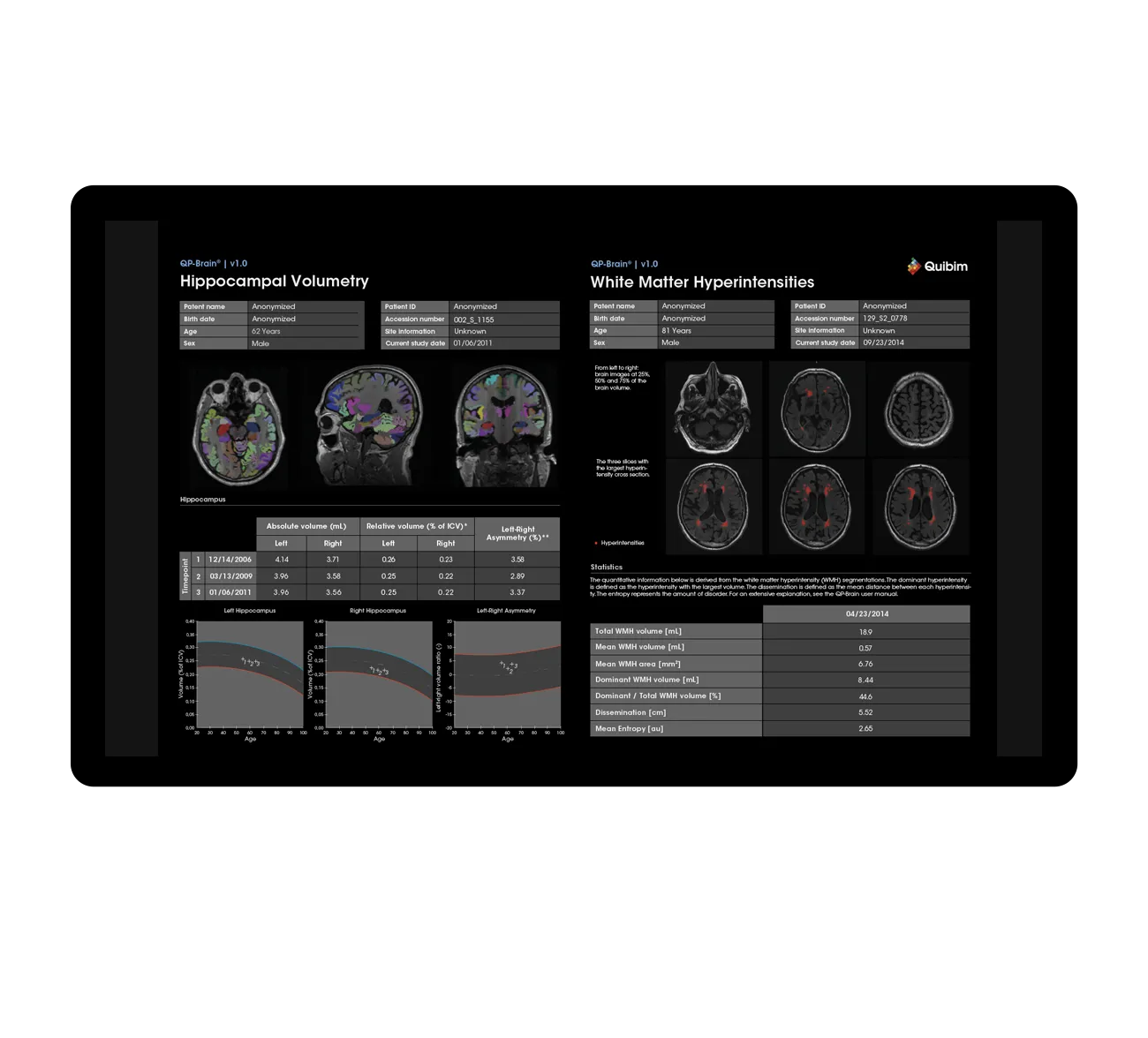 QP Brain sobre resonancia magnética cerebral