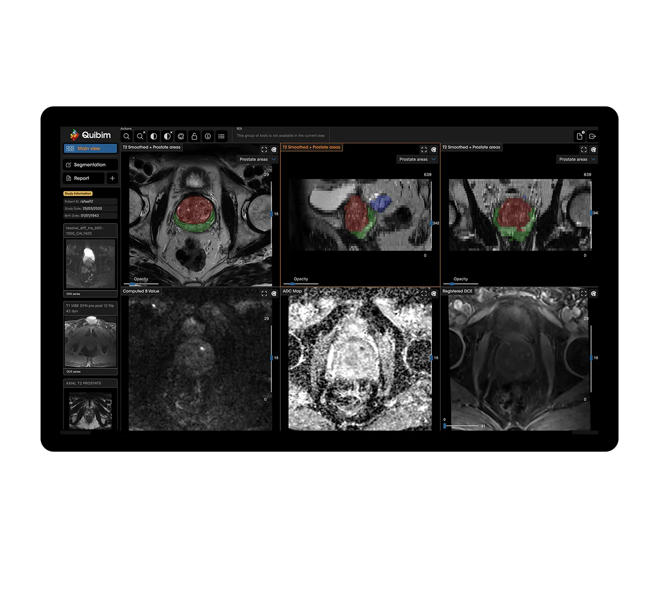 QP Prostate sobre resonancia multiparamétrica